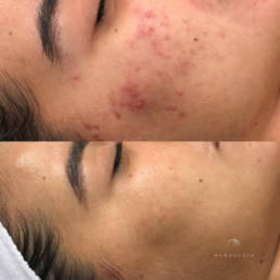 Microneedling - Timeless Aesthetics Beauty Lounge - Before After