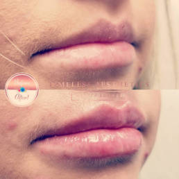 Injectables - Timeless Aesthetics Beauty Lounge - Before After